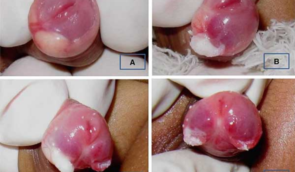 hình ảnh viêm bao quy đầu ở trẻ nhỏ