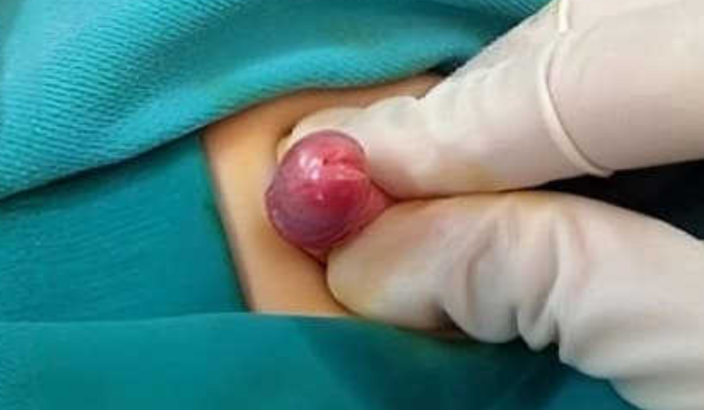 hình ảnh viêm bao quy đầu ở trẻ nhỏ