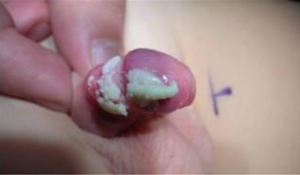 hình ảnh viêm bao quy đầu ở trẻ nhỏ