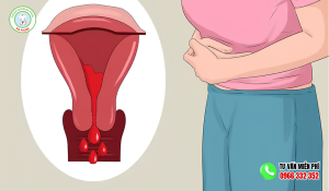 Kinh Nguyệt Ra Cục Thịt Như Bào Thai