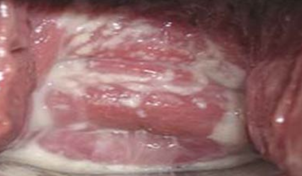 Hình ảnh bị nấm ở vùng kín nữ giới