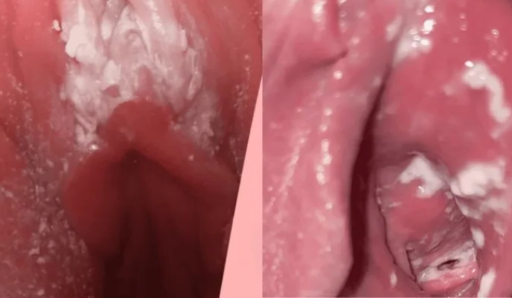 Hình ảnh nấm ngứa vùng kín