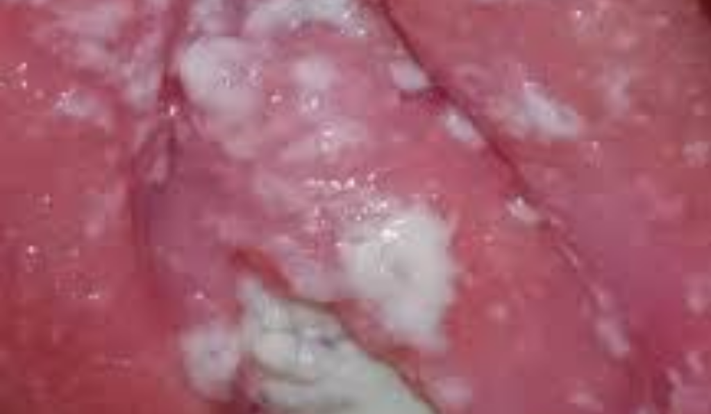 Hình ảnh bị nấm ở vùng kín nữ