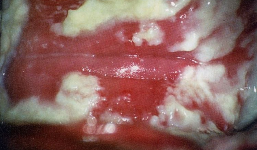 Hình ảnh vùng kín bị nấm Candida