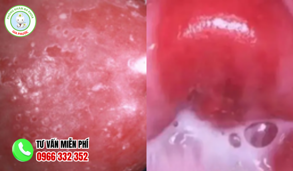 Hình Ảnh Bị Nấm Ở Vùng Kín Qua Từng Giai Đoạn (2026) 3 Hình ảnh bị nấm ở vùng kín