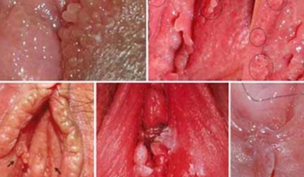 Hình ảnh ngứa vùng kín