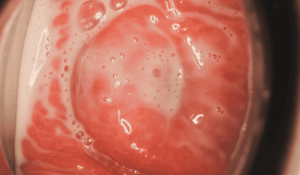  Hình ảnh ngứa vùng kín do trùng roi Trichomonas