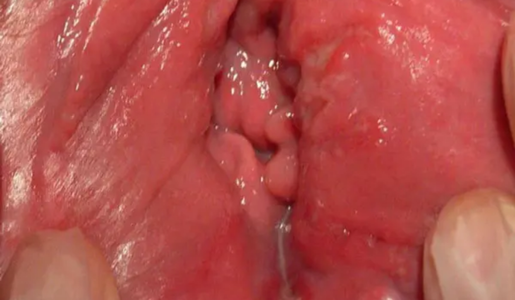 Hình ảnh ngứa vùng kín