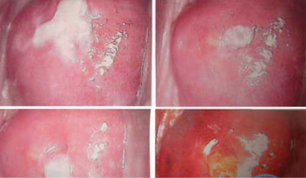 Viêm âm đạo do vi khuẩn 