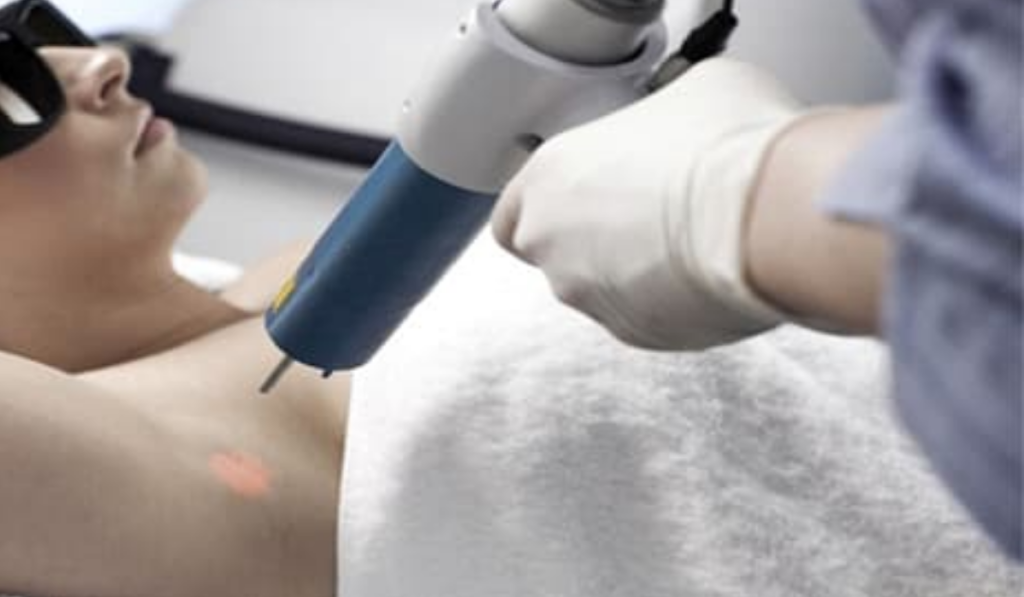 Trị hôi nách bằng công nghệ Laser Ultra Dry
