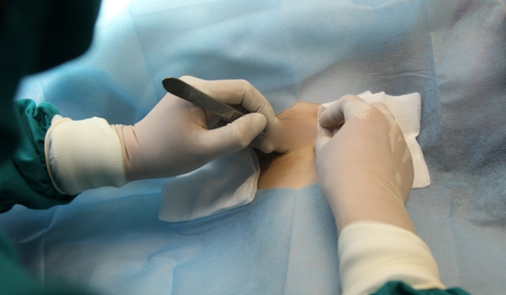 Tiểu phẫu cắt tuyến mồ hôi nách 