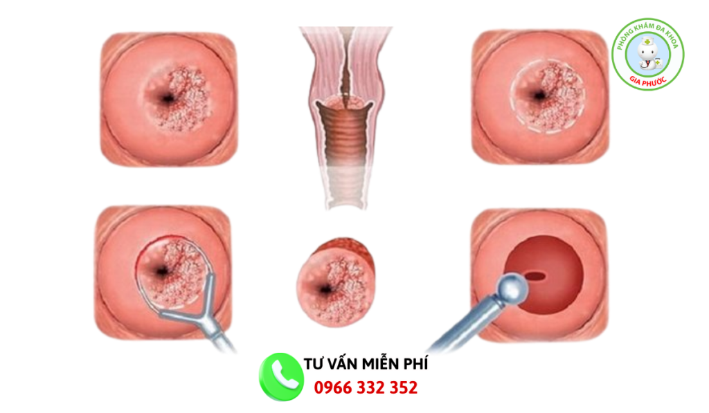 Đốt viêm lộ tuyến có đau không