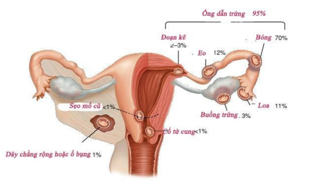 giải phẫu tử cung