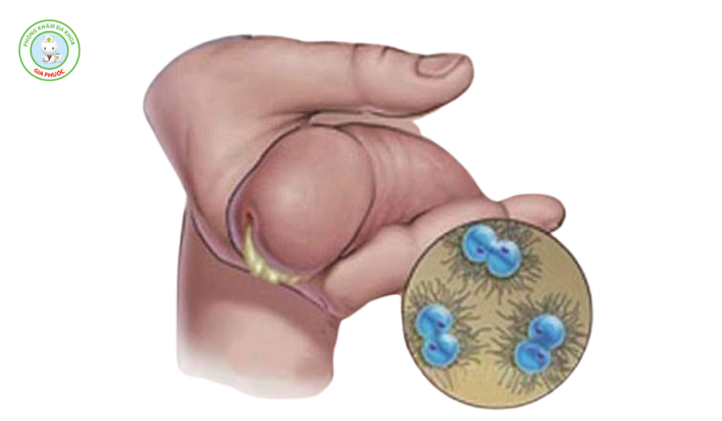 Hình ảnh bệnh lậu ở nam 