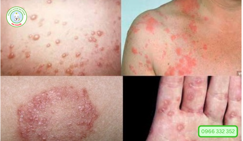 Hình ảnh bệnh lậu ở nam và nữ giới