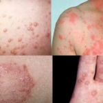 Hình ảnh bệnh lậu ở nam và nữ giới