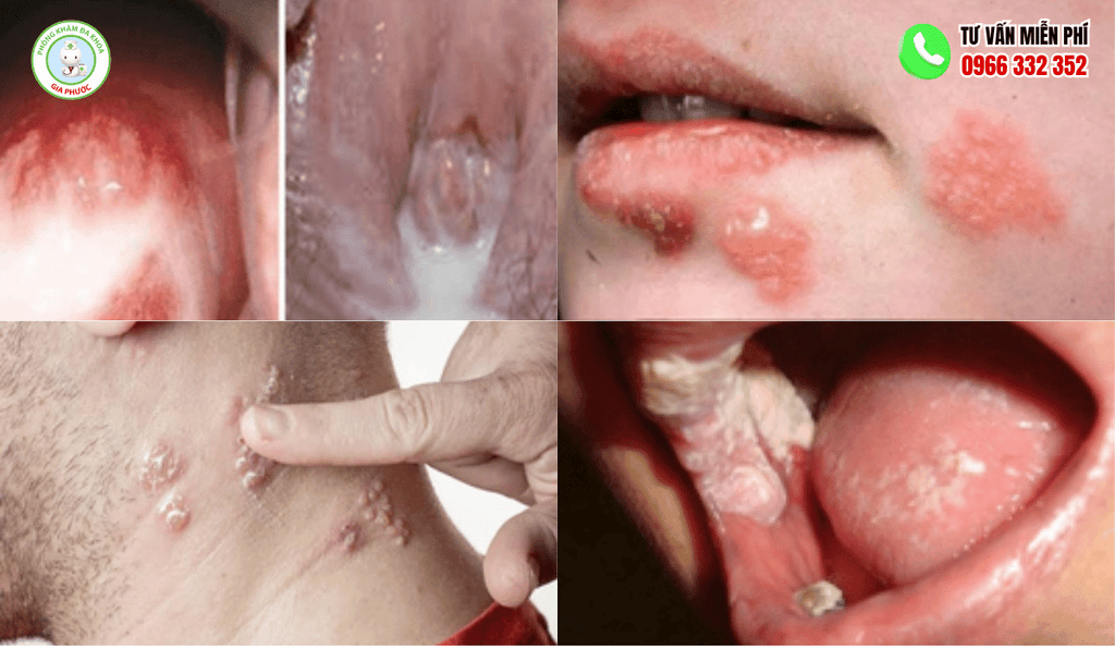 hình ảnh bệnh lậu