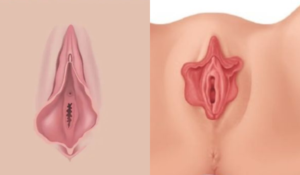 Hình ảnh môi bé bị phì đại cấp độ nặng