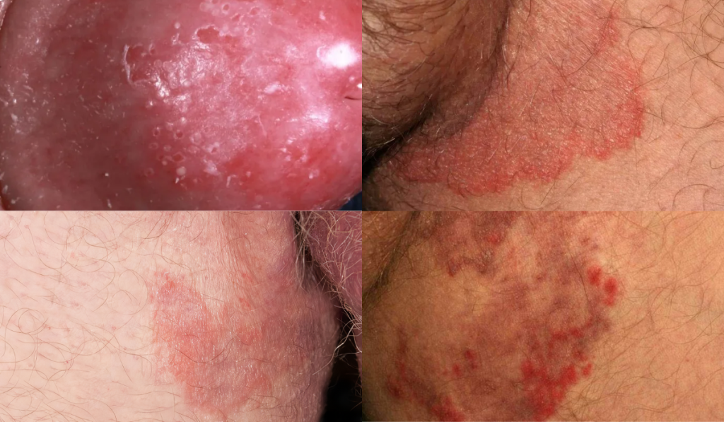 Hình ảnh ngứa vùng kín nam