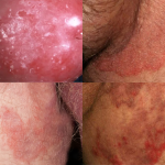 Hình ảnh ngứa vùng kín nam