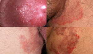 Hình ảnh ngứa vùng kín nam