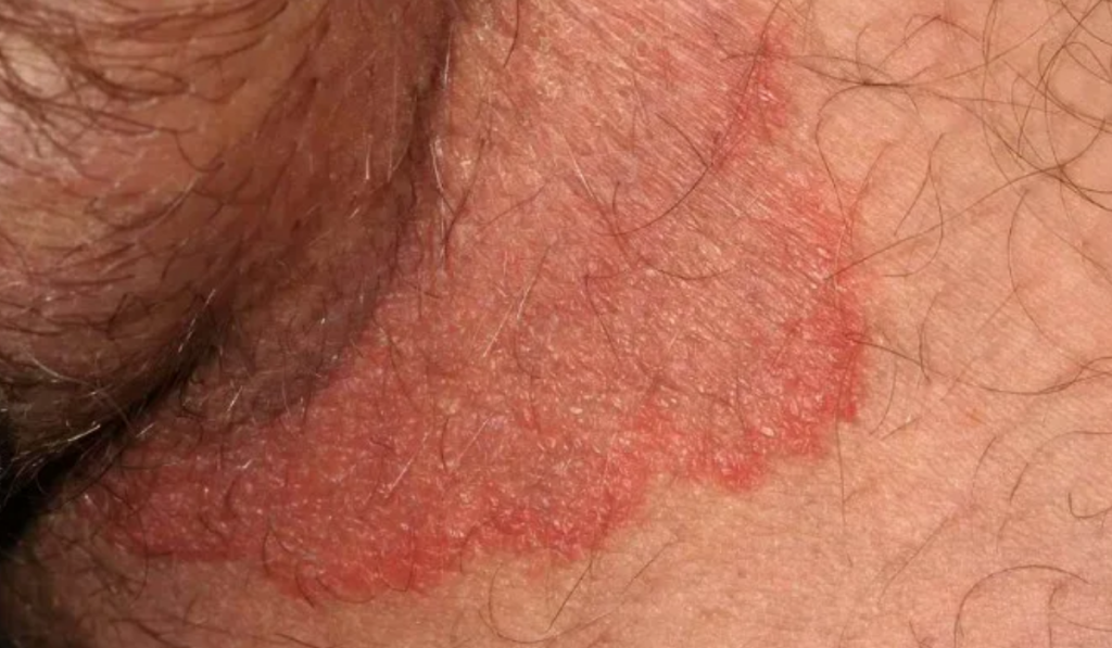 Hình ảnh ngứa vùng kín nam 