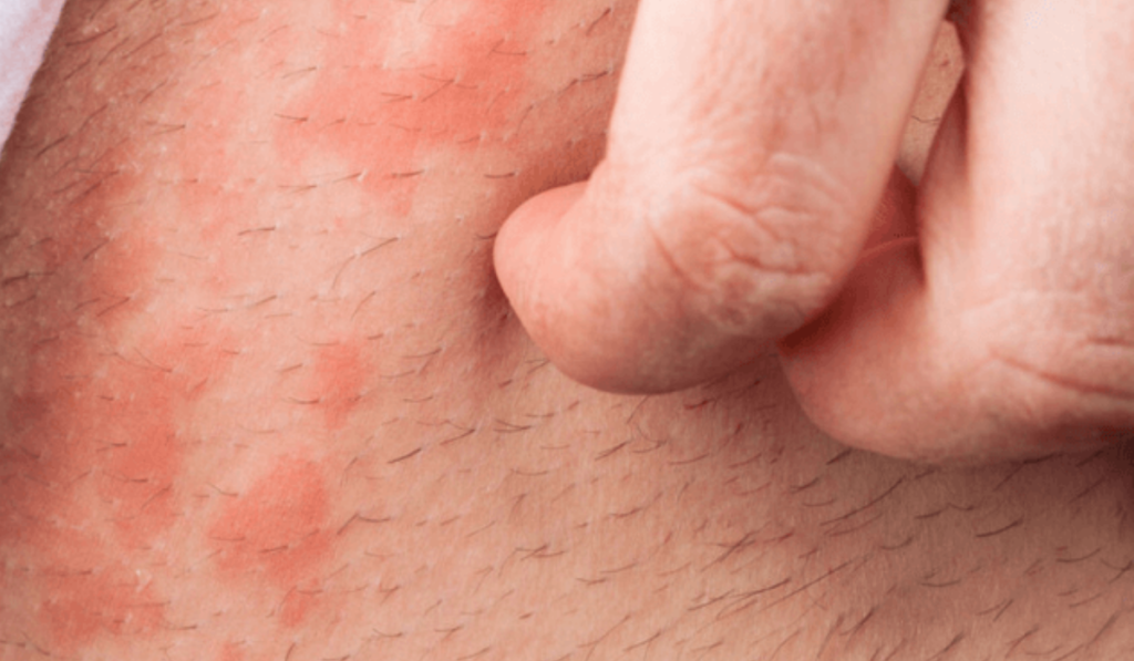 Hình ảnh ngứa vùng kín nam