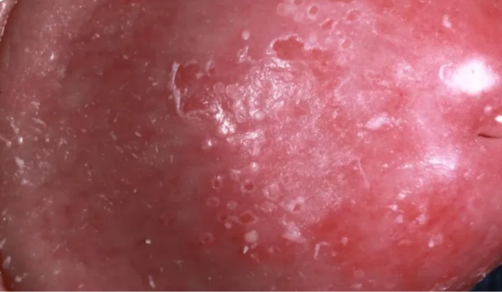 Hình ảnh ngứa vùng kín nam