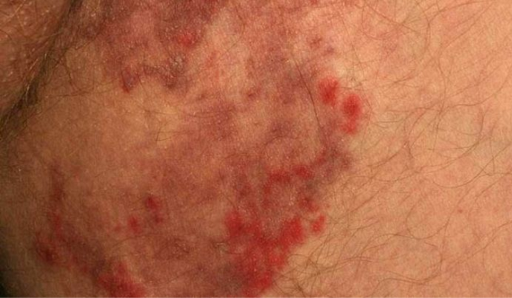 Hình ảnh ngứa vùng kín nam