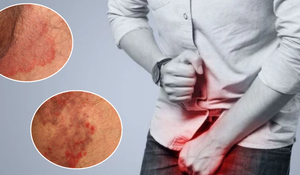 Hình ảnh ngứa vùng kín nam