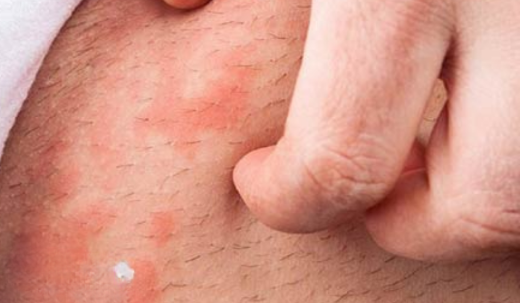 Hình ảnh ngứa vùng kín nữ