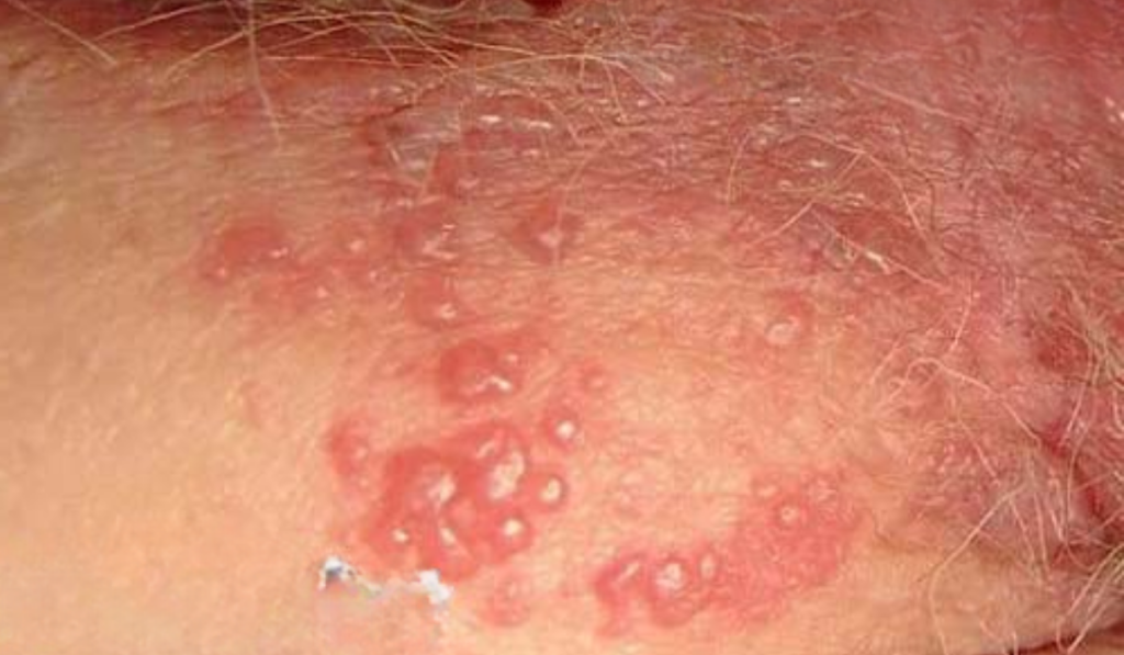 Hình ảnh ngứa vùng kín nữ