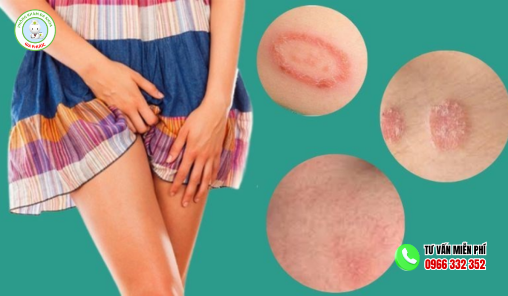 Hình ảnh ngứa vùng kín nữ