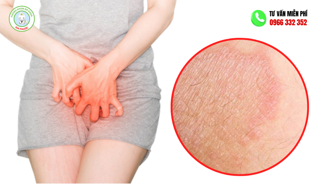 Hình ảnh ngứa vùng kín nữ