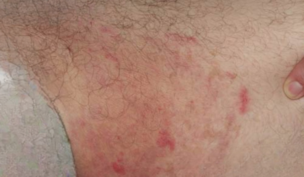 Hình ảnh ngứa vùng kín nữ