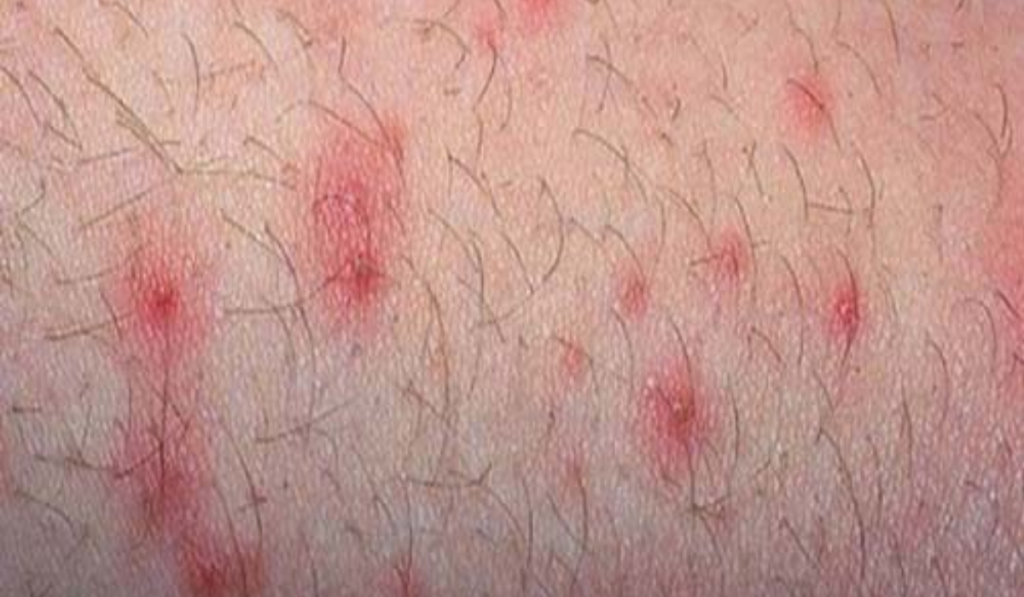 Hình ảnh ngứa vùng kín nữ