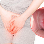 Hình ảnh viêm lộ tuyến