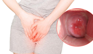 Hình ảnh viêm lộ tuyến