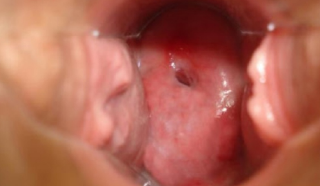 Hình ảnh viêm lộ tuyến tử cung