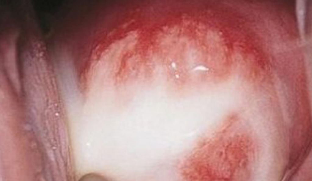 Hình ảnh viêm lộ tuyến tử cung