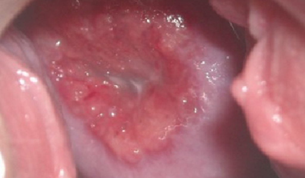 Hình ảnh viêm lộ tuyến tử cung