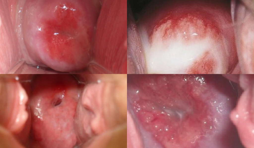 Hình ảnh viêm lộ tuyến tử cung 