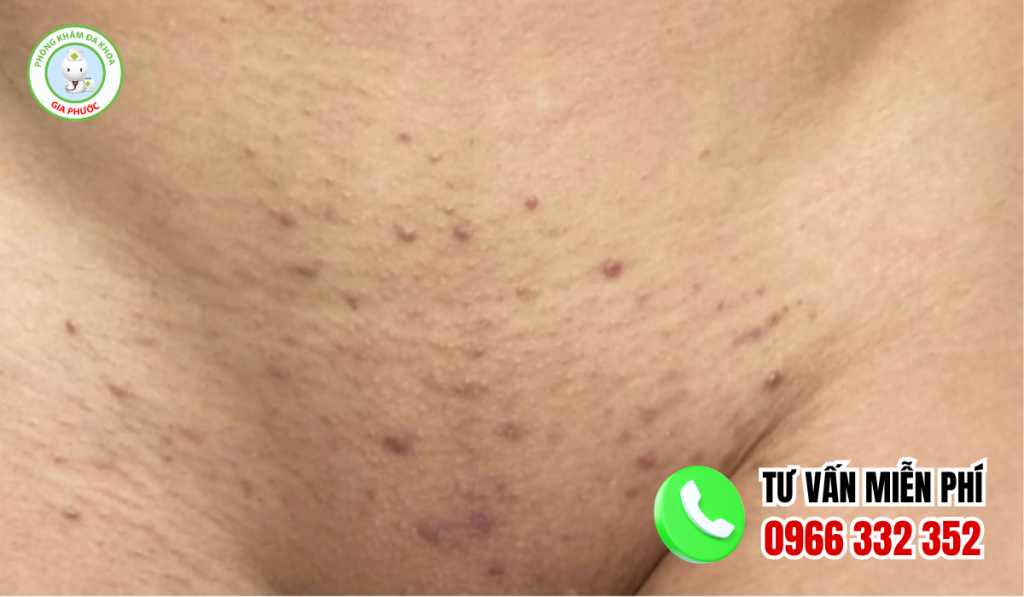 Hình ảnh viêm nang lông ở vùng kín