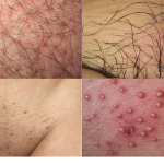 Hình ảnh viêm nang lông vùng kín chân thật