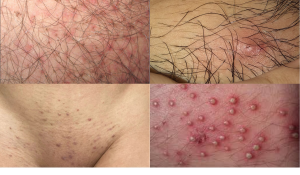 Hình ảnh viêm nang lông vùng kín chân thật