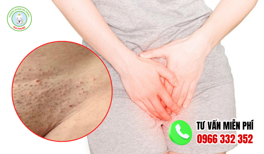 Hình ảnh viêm nang lông vùng kín