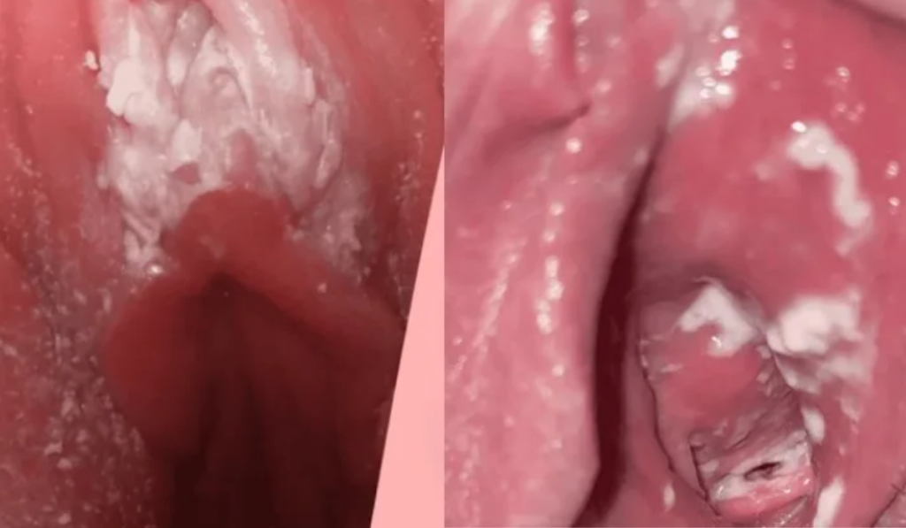 Khí hư dính bết ở mép âm hộ hoặc bám thành mảng vào thành âm đạo