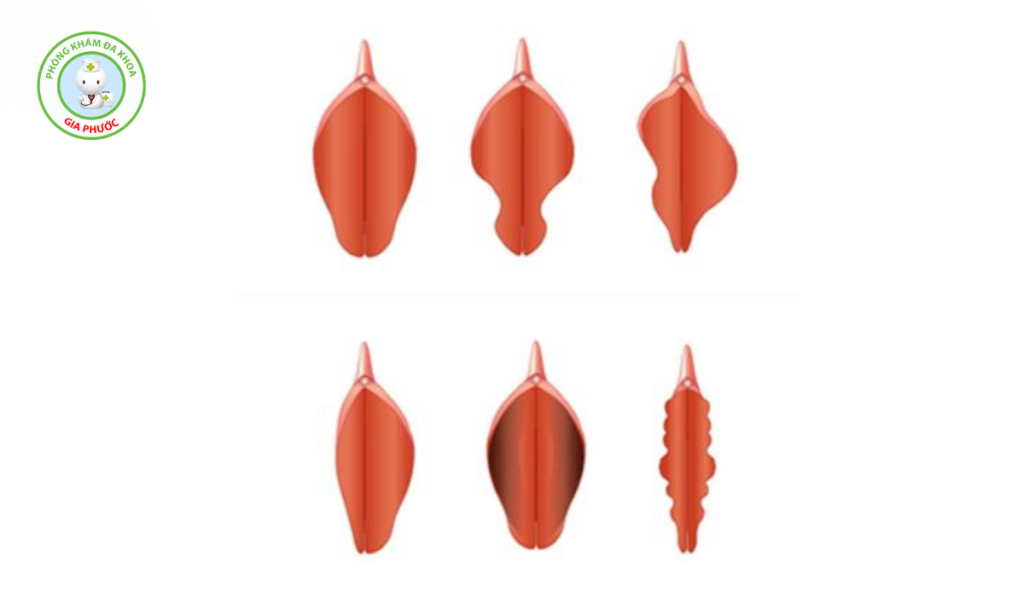 Thế nào là môi bé bị phì đại?