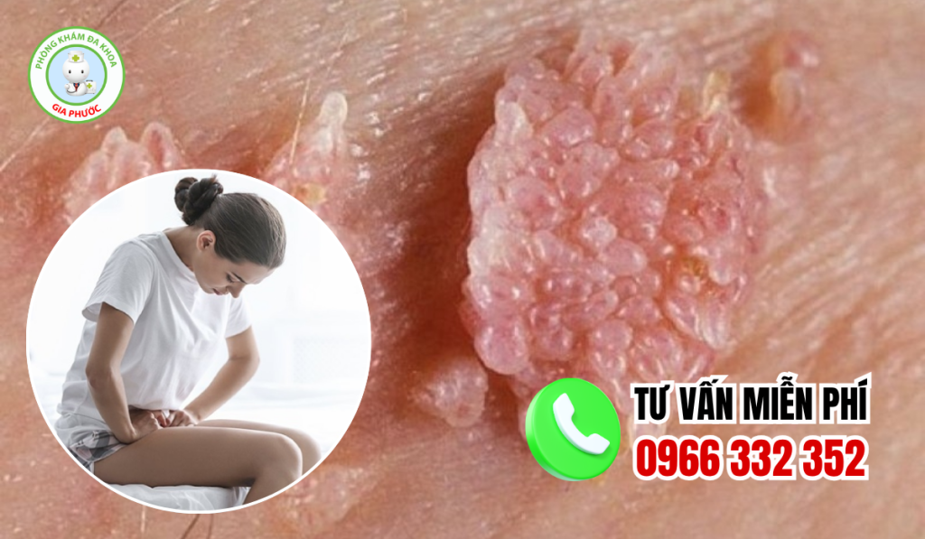 Cách chữa gai sinh dục nữ tại nhà