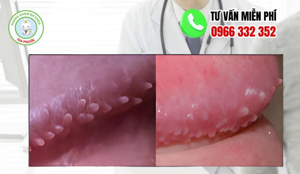 Gai Sinh Dục Nam Là Gì? Hình Ảnh, Nguyên Nhân Và Cách Trị (2026) 5 Hình ảnh gai sinh dục nam